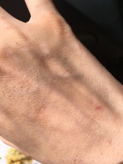 Tiny red dots on hand and arm
