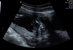 Early gender scan-Is it really a girl?
