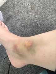 Is this just a bad bruise?