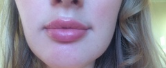 Sooo, who’s tried lip fillers?!