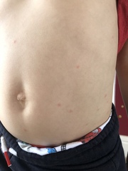 Have any of you seen this type of rash before?