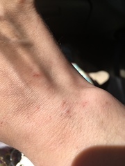 Tiny red dots on hand and arm