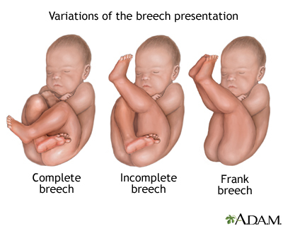Has anyone had a ECV followed by an induction?... or C-SECTION?!