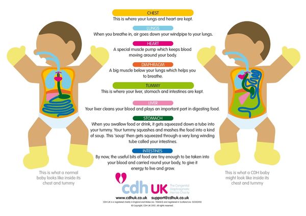 Baby Diagnosed with cdh