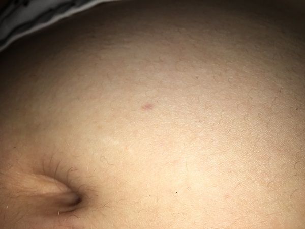 Stretch mark or something else?