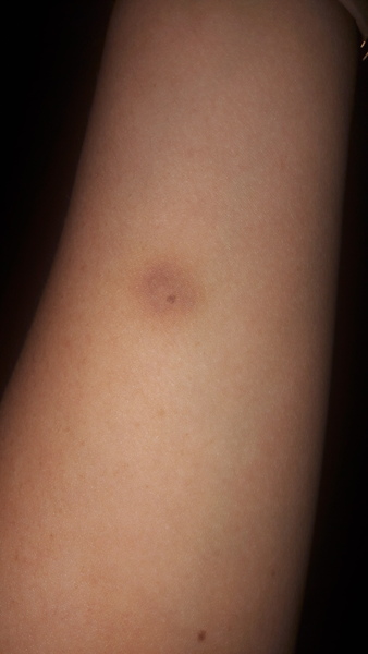 Mole with bruise,  pic attached. I guess it's nothing?