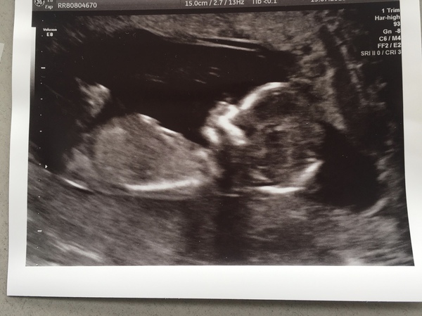 Girl or boy?