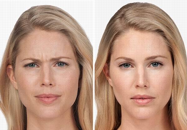 To ask for your opinion on botox