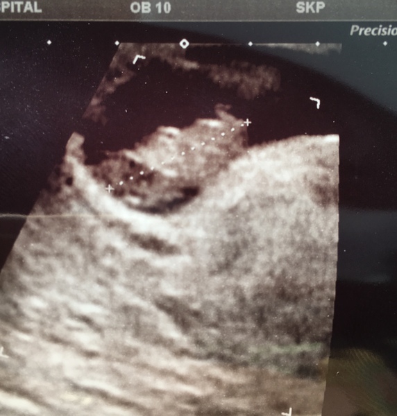 Pregnancy after loss: spring 2019 edition (The Brexit Babes) 🐧