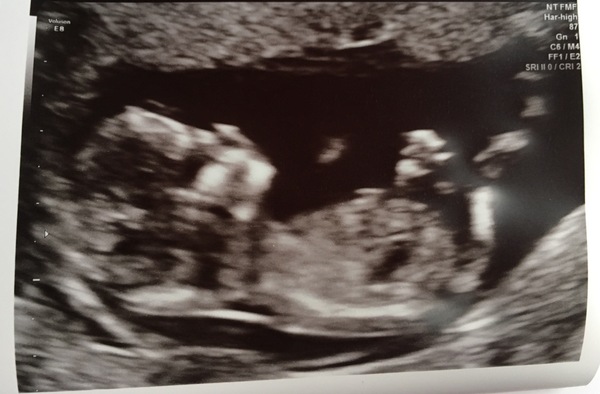 Feb 2019 Babies thread 6. Into the second trimester