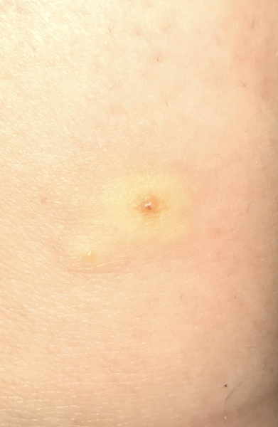 What the heck is biting me? Picture included.