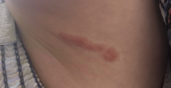 Possibly shingles??