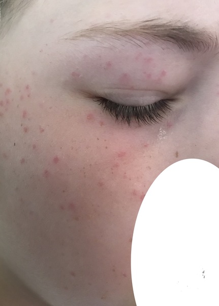 to ask what has bitten me?