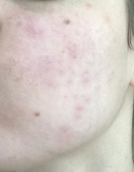 Sudden spots and redness on face - HELP!