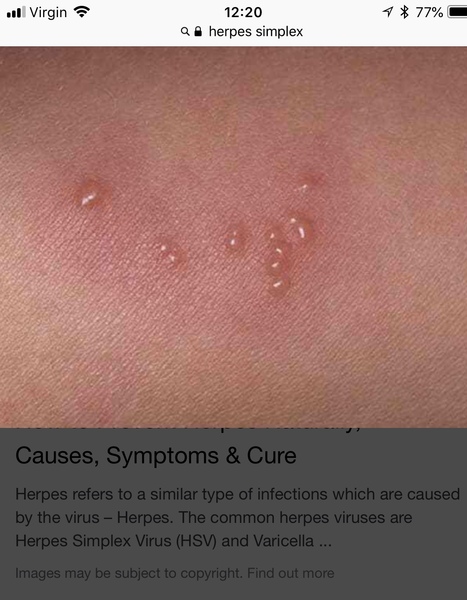 Anyone able to say what this is on my face? Impetigo?