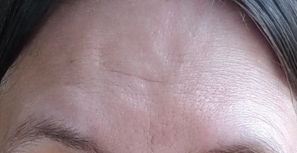 To ask about scarring after huge cut? Have you dcs had scars?