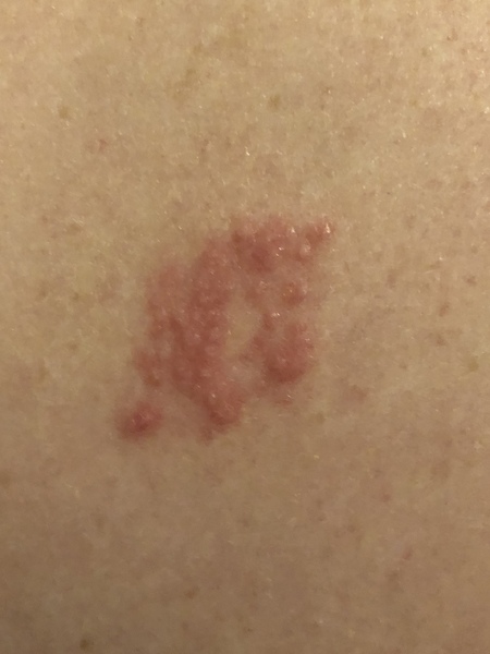 What is this on my husbands back???