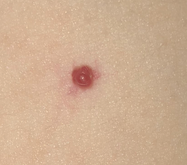 What's this red thing on ds tummy?