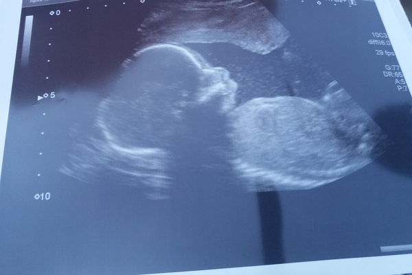 More Christmas Cake! Pregnancy after loss (thread 3)