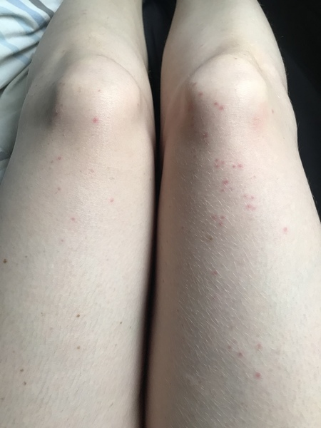 to ask what has bitten me?