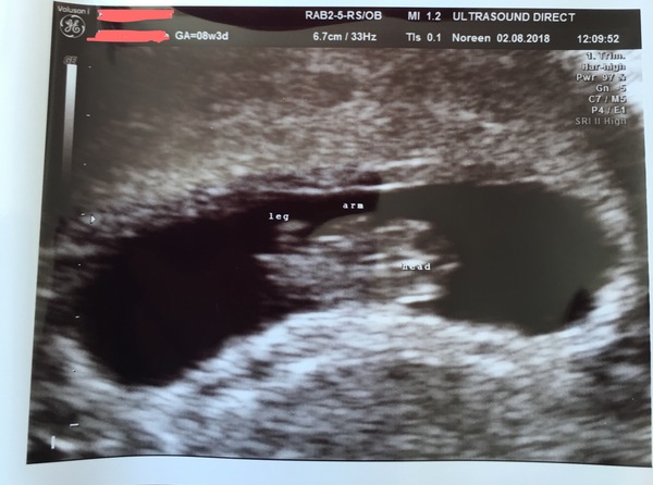 Fresh Start thread for pregnancy after miscarriage or loss