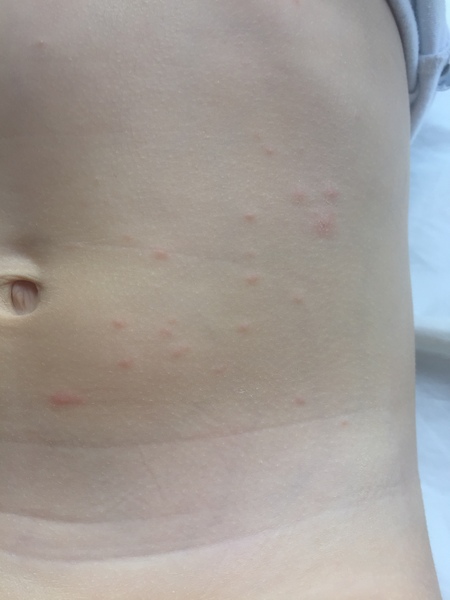 Does this look like chicken pox? - photos