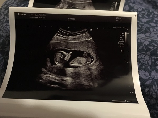 Gender from 12 week scan