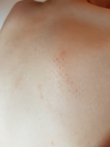 Petechia rash on 12 year old...normal?