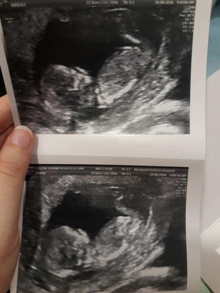 Feb 2019 Thread 5: 12 week scans and the start of the second trimester.