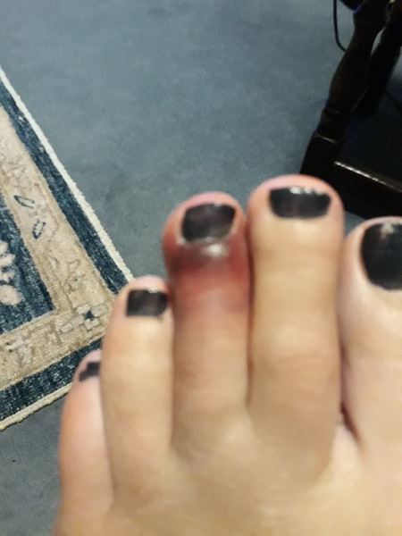 To think I've broken a toe?