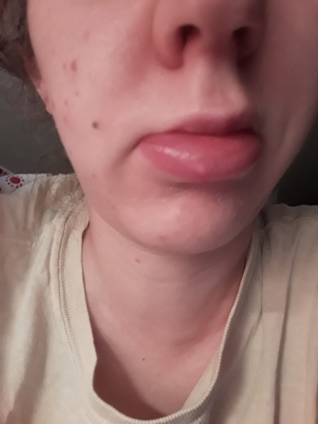 I just got stung by a wasp!