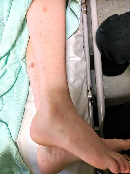 Can anyone identify this rash