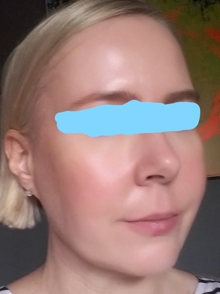 Face tinkerers - Profhilo is flippin' brill