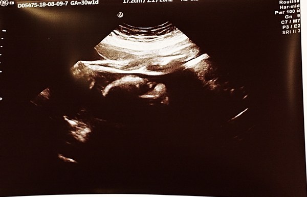 Fresh Start thread for pregnancy after miscarriage or loss