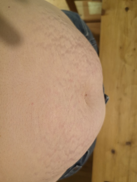 Do stretch makes worsen with another pregnancy?