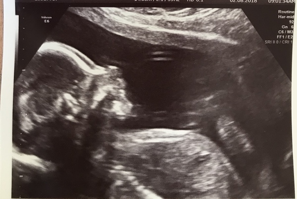 Fresh Start thread for pregnancy after miscarriage or loss