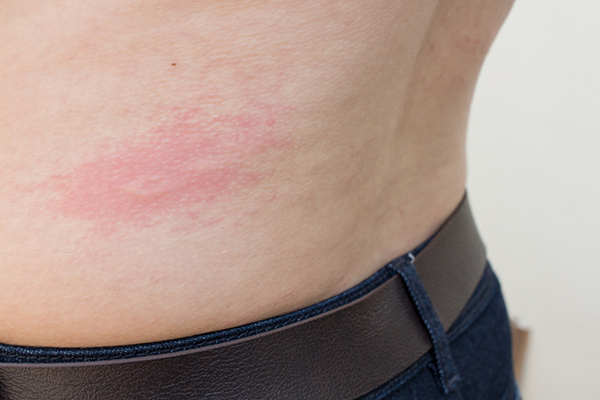 "Allergic reaction"  or something else?