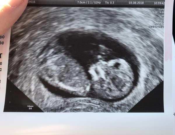 Feb 2019 Thread 5: 12 week scans and the start of the second trimester.