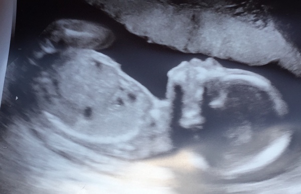 They said girl at scan - pic inc help.