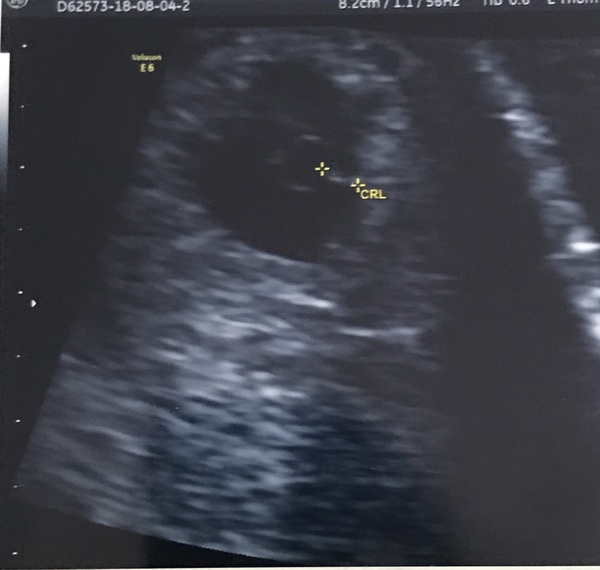 Pregnancy after loss: spring 2019 edition (The Brexit Babes) 🐧