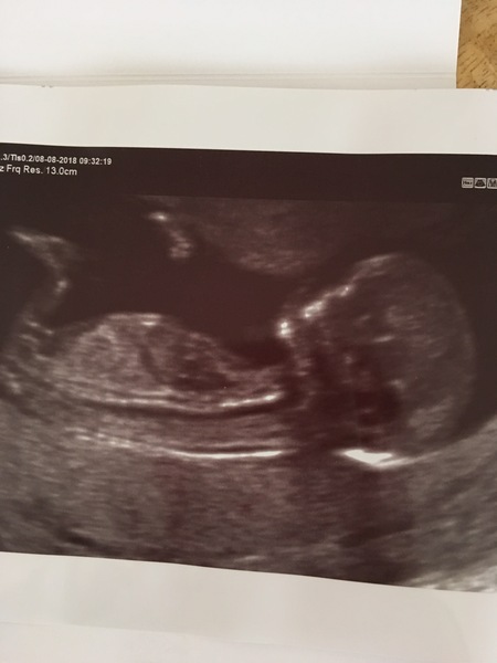 Feb 2019 Thread 5: 12 week scans and the start of the second trimester.