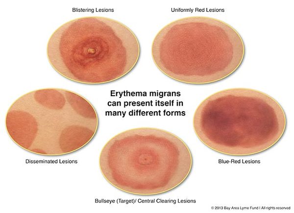 To remind you, especially in the holidays, about b******* ticks?!