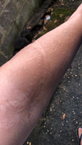Aibu to ask about your scars?