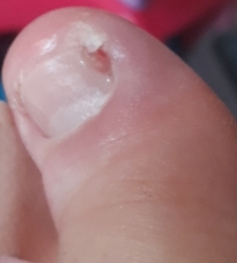 Ingrown toenail - pic