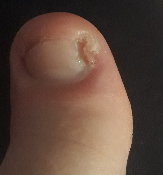 Ingrown toenail - pic