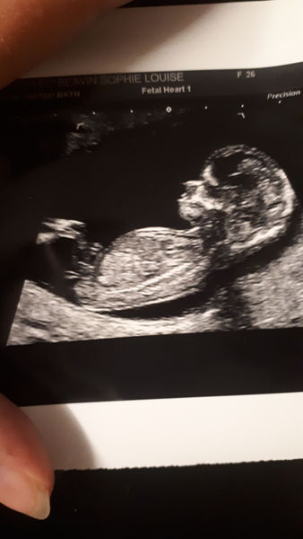 Boy or girl 13 week scan