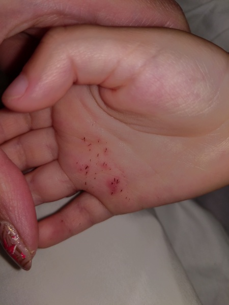 To take my son to GP? Splinters