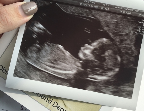 Girl or boy?