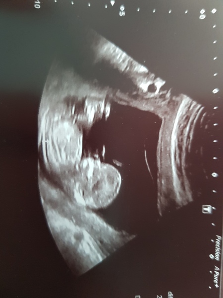 Boy or girl at 13 weeks?