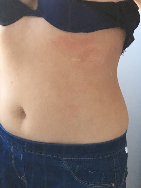 Rash - what is it? Pics included!